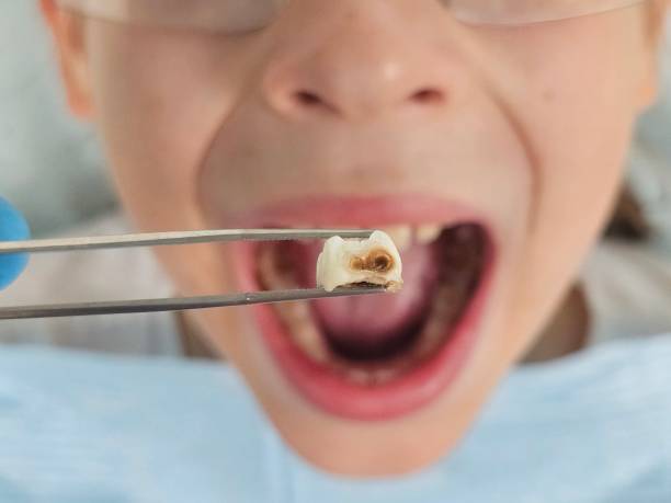 Best Emergency Wisdom Tooth Extraction in Ironton, OH